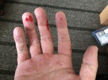 汗疱の治療1日目