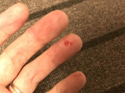 汗疱が割れるとこういう状態になります