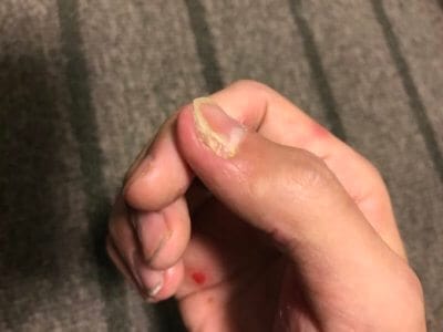 汗疱にビオチン治療してみる2ヶ月目の爪の変化横からの写真