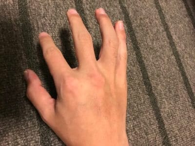 汗疱にビオチン治療2ヶ月目手の甲