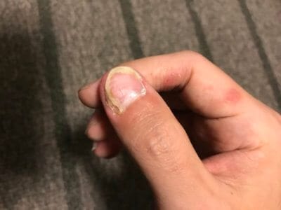 汗疱にビオチン治療してみる2ヶ月目の爪の変化