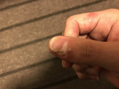 汗疱で爪がはがれて3ヵ月