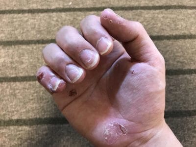 汗疱でビオチン治療3か月目