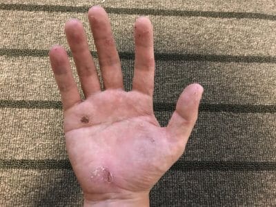 汗疱ビオチン3ヵ月手のひら