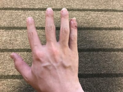 汗疱ビオチン3ヵ月手の甲